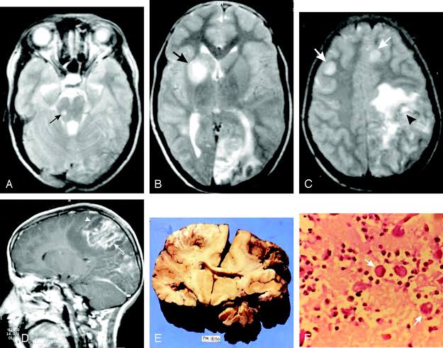 Amebic Encephalitis